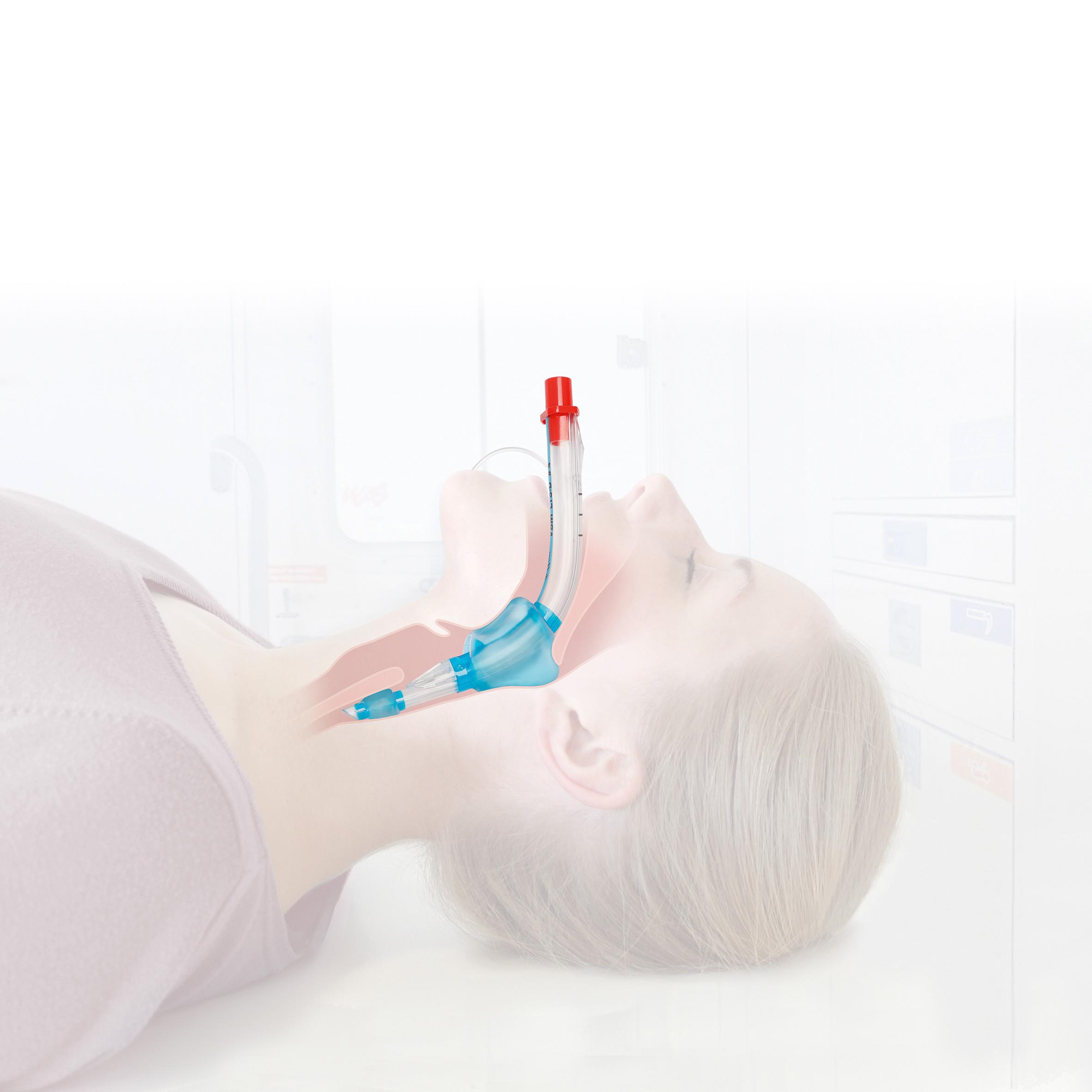 Eine Frau liegt sediert auf dem Rücken, ein Larynx Tubus LTS-D, steril - M ist durch die Nase bis in die Luftröhre eingeführt.