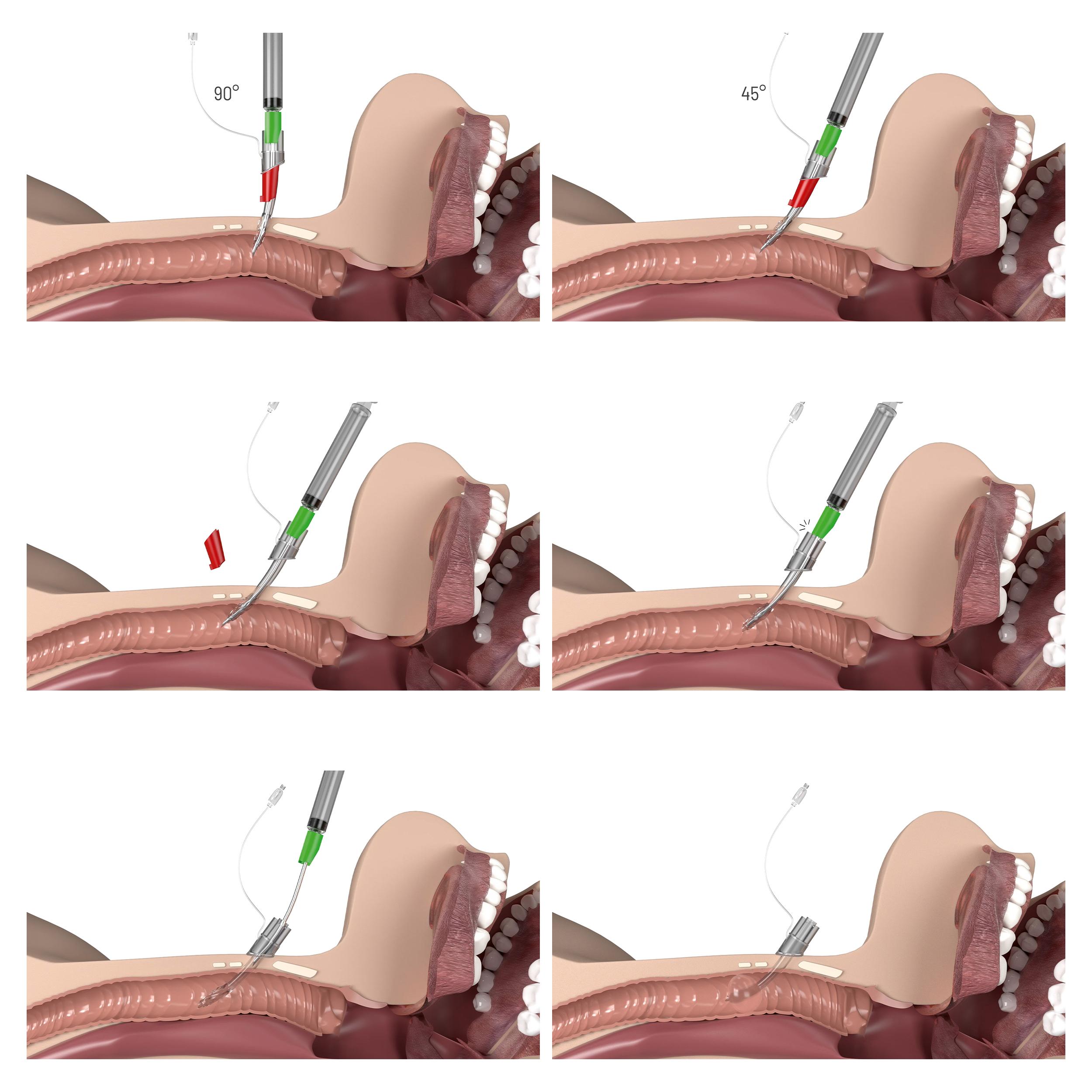 Sechs Diagramme zeigen Schritt für Schritt die Anwendung des VBM Quicktrach II Koniotomie Set mit Nadel, Kanüle und Cuff am Hals eines Patienten.