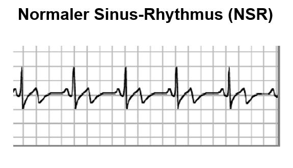 Diagramm zeigt einen gleichmäßigen Sinusrhythmus mit konstanten Intervallen und stabiler Herzfrequenz bei etwa 60 Schlägen pro Minute.