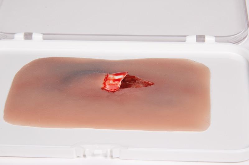 Erler-Zimmer Woundmoulage Offener Knochenbruch mit realistisch dargestellter, blutiger Schusswunde in transparenter Aufbewahrungsbox.