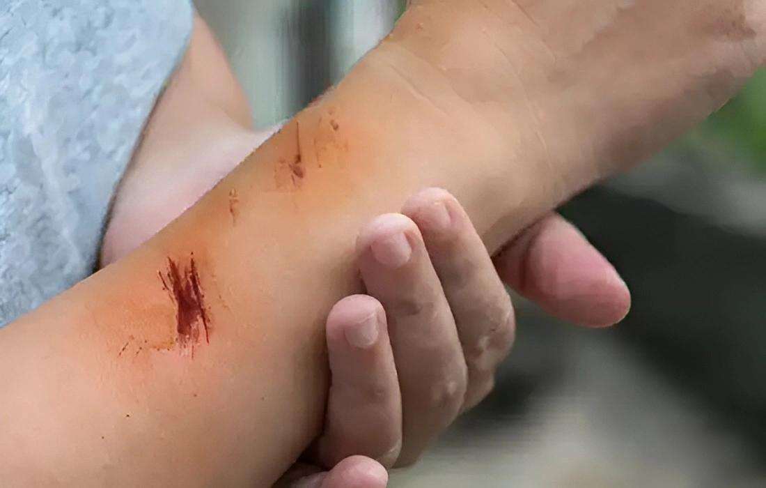 Ein heller Arm mit drei unterschiedlich großen, frischen und rötlichen Schnittverletzungen nahe dem Handgelenk, sanft berührt von einer Hand.