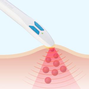 Ein weißes medizinisches Gerät mit blauen Tasten bestrahlt punktuell rote Hautstellen mit fokussiertem Rotlicht.