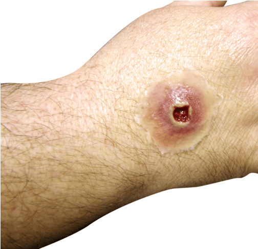 Eine helle Hand trägt eine kleine, runde Techline Moulage Schusswunde Eintritt klein selbstklebend mit realistisch wirkender Rötung und angehobenem Rand auf dem Handrücken.