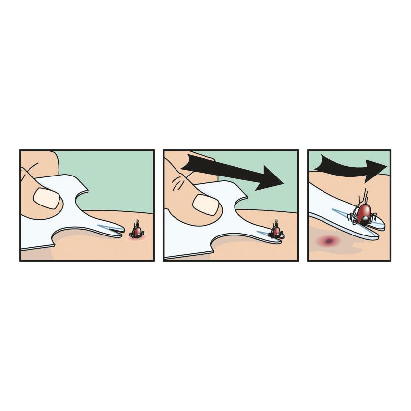 Drei Illustrationen zeigen die Anwendung der Zeckenkarte mit Lupe aus transparentem Kunststoff zur sicheren Zeckenentfernung Schritt für Schritt.