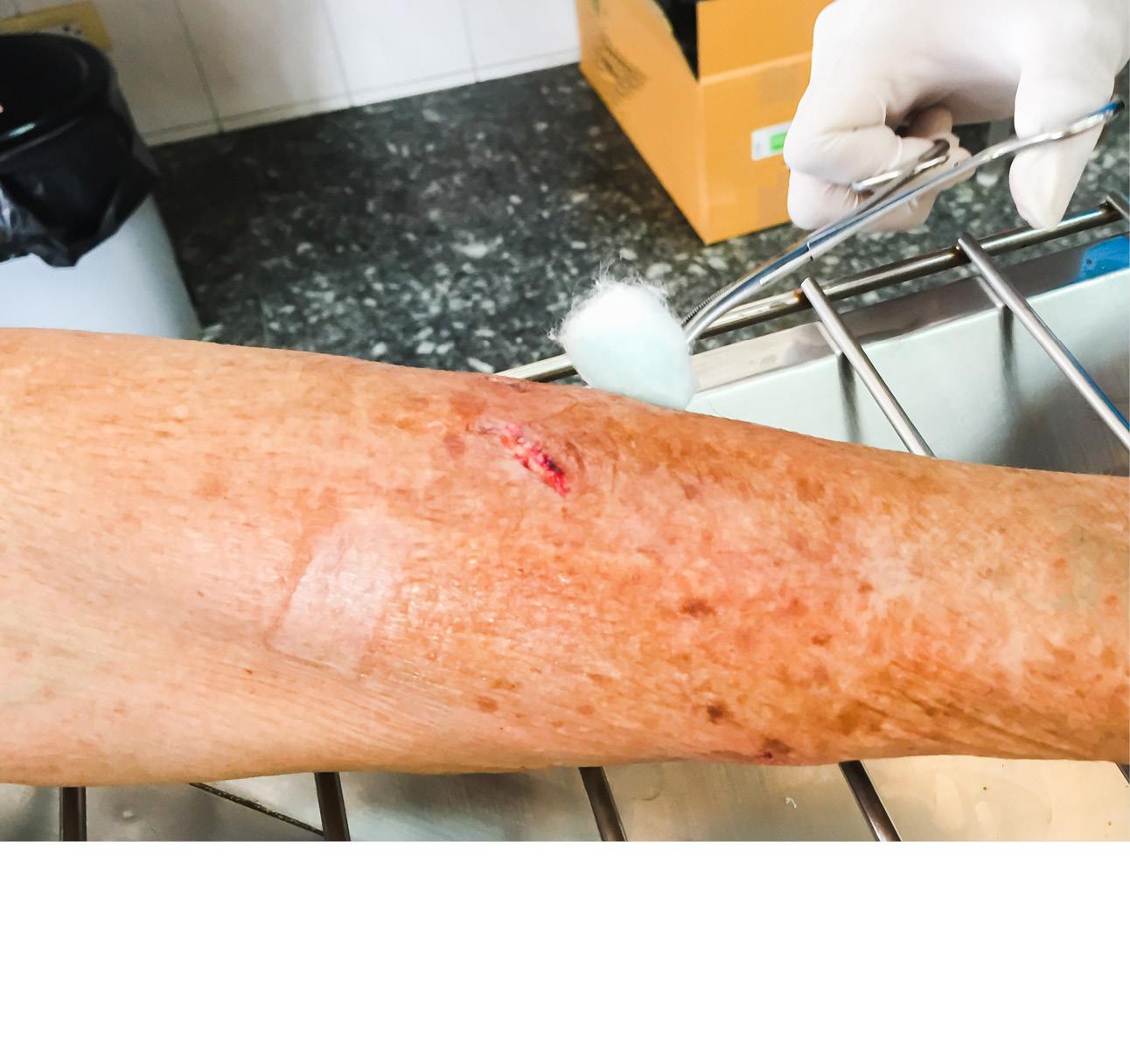 Ein Arm mit Verätzungen in Nahaufnahme, der gerade medizinisch versorgt wird.