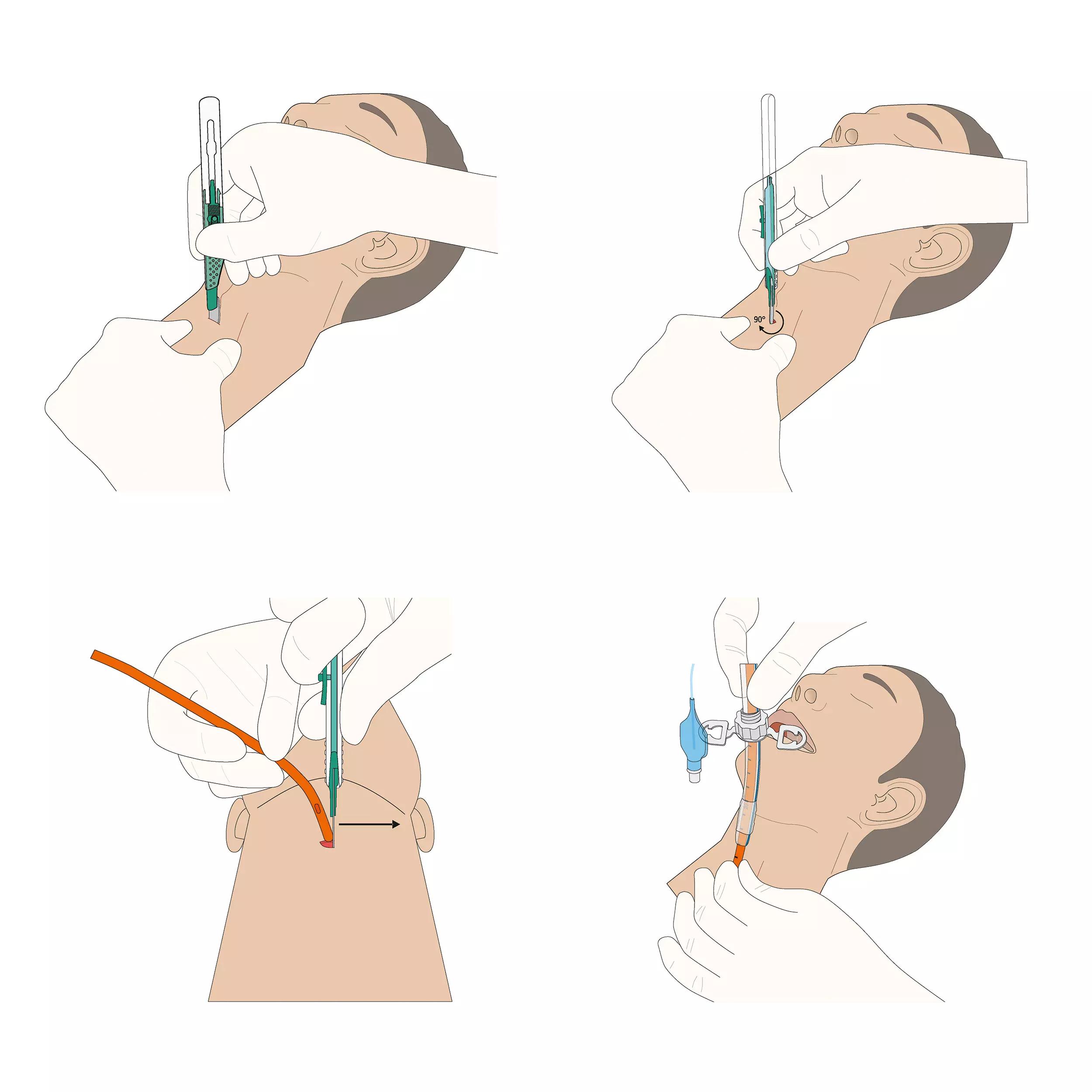 Vier Illustrationen zeigen die Anwendung des VBM ScalpelCric Koniotomie-Set mit Skalpelltechnik, Stichinzision, Drehung und Platzierung des Tubus nacheinander.