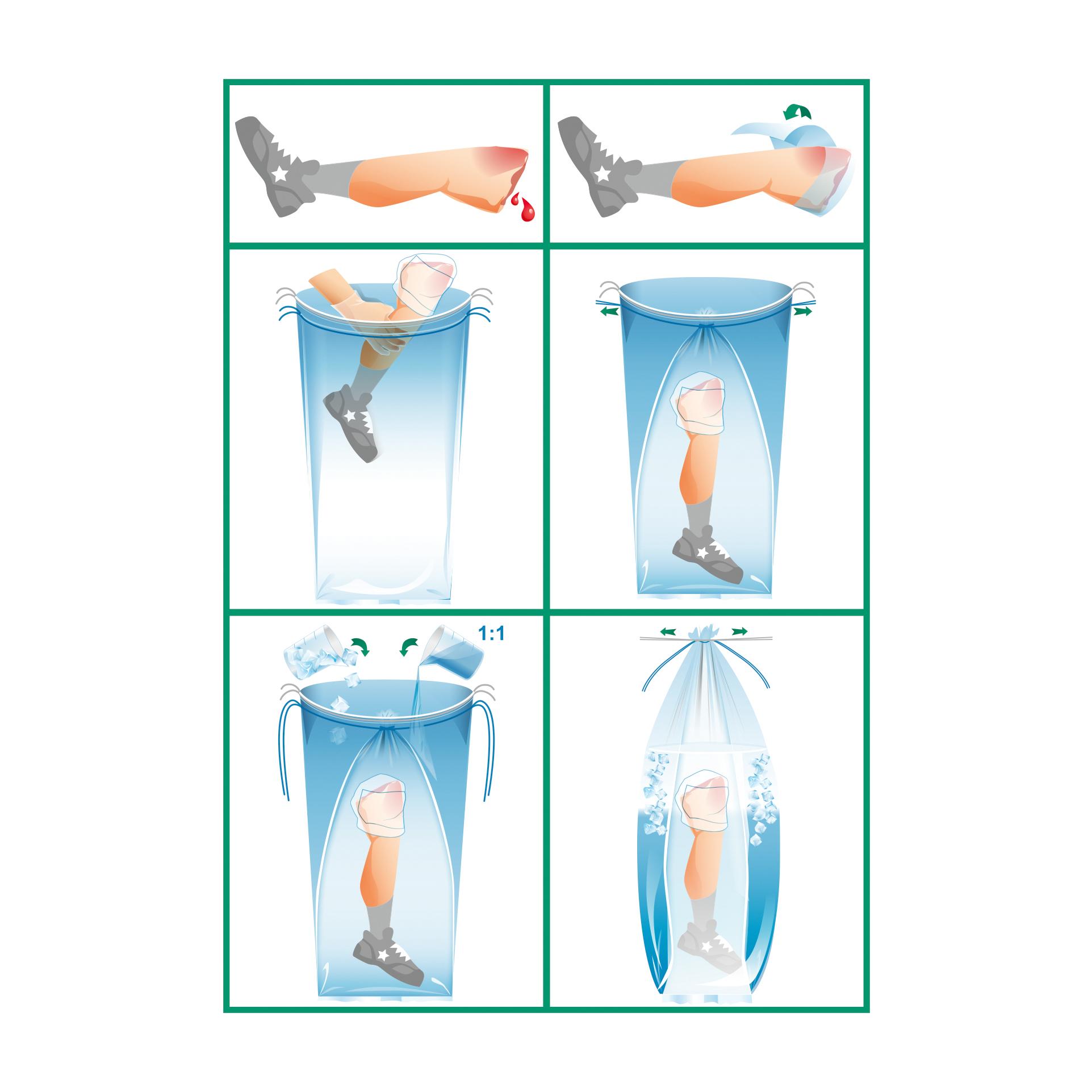 Schritt-für-Schritt-Anleitung zur Nutzung des WERO Replantat-Beutel, steril - Bein mit Doppelwandsystem, Beinsicherung und Anziehen der Kordel.