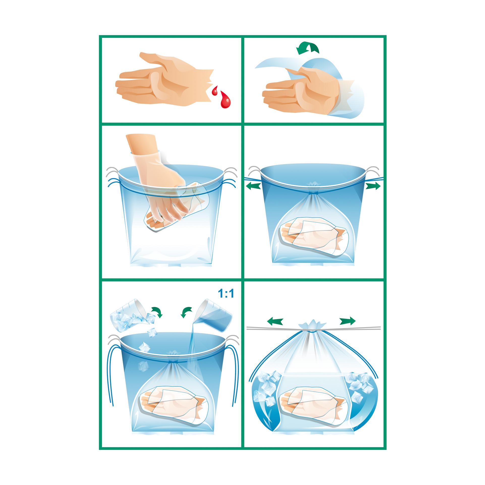 Eine verletzte Hand wird in einem WERO Replantat-Beutel, steril - Hand, in Eiswasser gekühlt, um den Schutz vor Hitze, Kälte und Keimen zu gewährleisten.