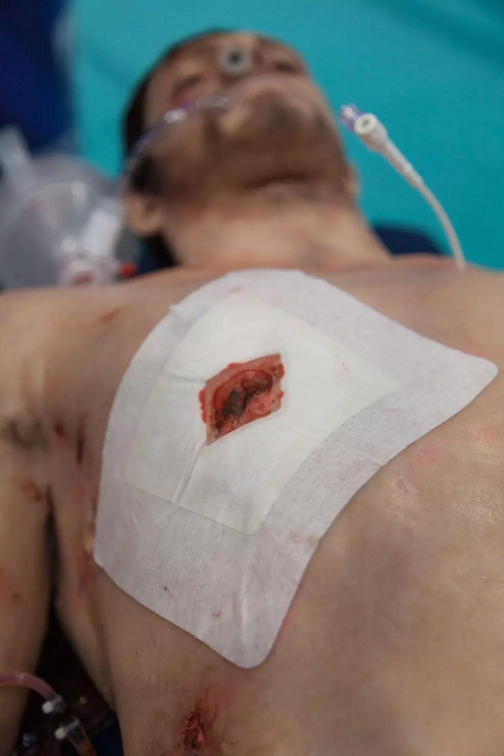 Russell Chest Seal™ schützt einen verschlossenen Schnitt auf der Brust, bedeckt von weißem Verband, mit angebrachtem Drainageschlauch und transparenter Auffangkammer.