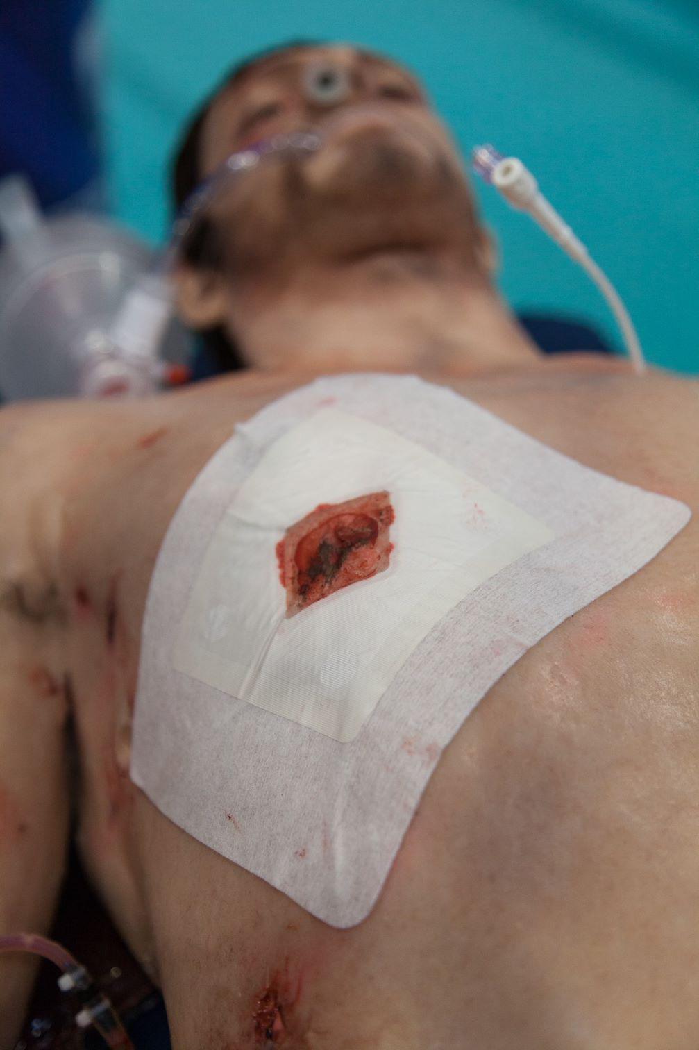 Russell Chest Seal™ schützt einen verschlossenen Schnitt auf der Brust, bedeckt von weißem Verband, mit angebrachtem Drainageschlauch und transparenter Auffangkammer.