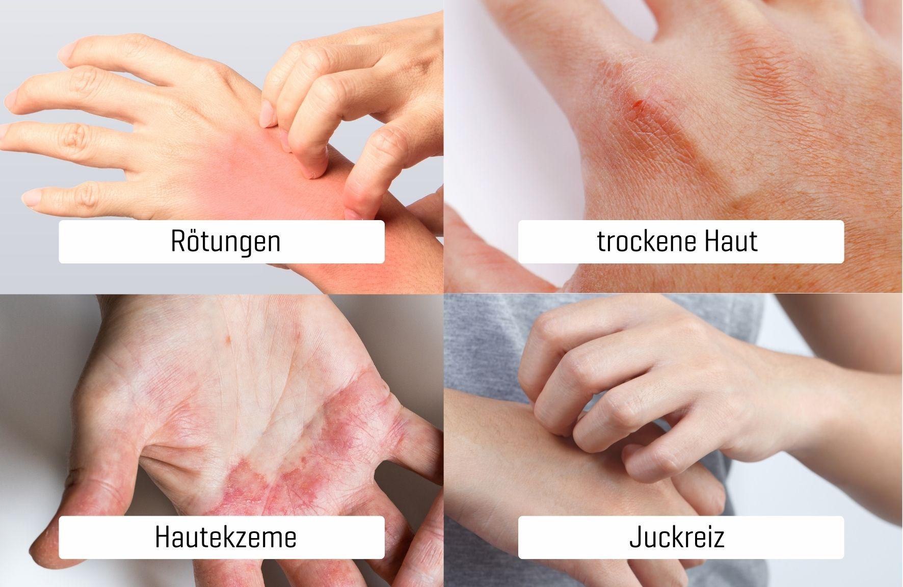 Verschiedene Hände mit sichtbaren Hautproblemen: Rötungen, trockene Haut, Ekzeme und Juckreiz, jeweils als Nahaufnahme dargestellt.