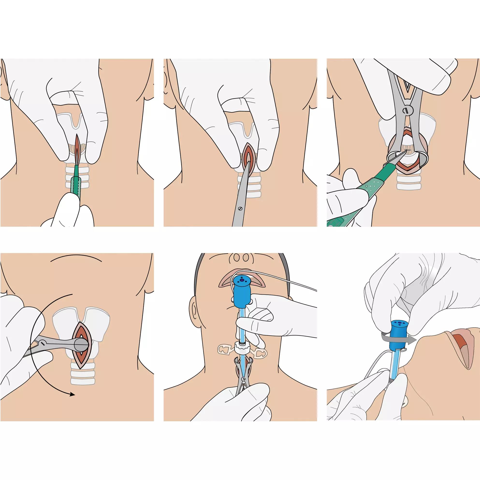 Sechs Illustrationen zeigen die Anwendung des VBM Surgicric II Chirurgisches Koniotomie-Set mit kombiniertem Tubus und Dilatator am Hals einer Patientin.
