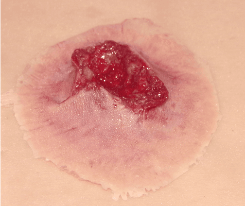 Eine Techline Moulage Schusswunde Austritt mittel selbstklebend simuliert eine runde, oberflächliche Schusswunde mit rotem, unregelmäßigem Gewebe und Blutspuren.