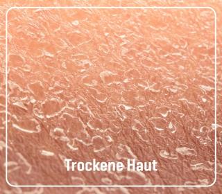 trockene_haut
