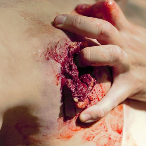 Eine Hand hält vorsichtig eine blutende, oberflächlich verletzte Hautpartie mit sichtbarem Gewebe und leicht rissiger, glänzender Haut.