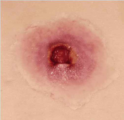 Nahaufnahme einer Techline Moulage Schusswunde Eintritt klein selbstklebend, rund mit sichtbaren Blut- und Lymphgefäßen, auf heller Haut platziert.