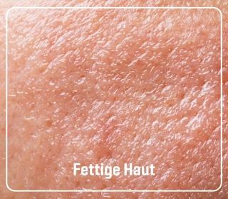 fettige_haut