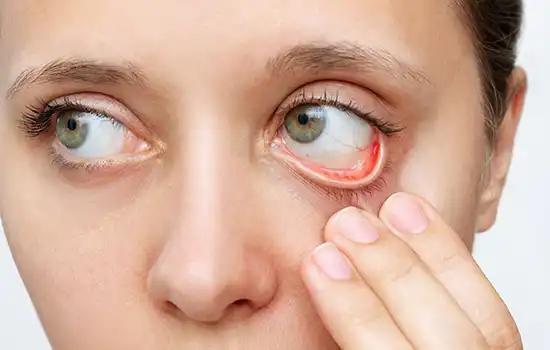Ein gerötetes, gereiztes Auge mit sichtbaren Wimpern wird sanft von einer Hand am Lid berührt.
