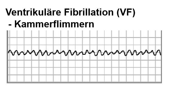 Diagramm der elektrischen Herzaktivität bei ventrikulärer Fibrillation mit wellenförmigem Kurvenverlauf über die Zeit.