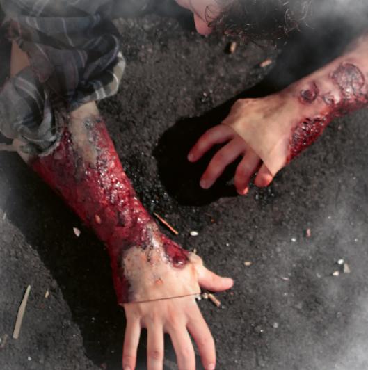 Der linke Unterarm einer Person mit Techline Moulage Schwere Verbrennung - Unterarm (links) zeigt realistisch nachgebildete, schwere Brandwunden mit blutroten Details.